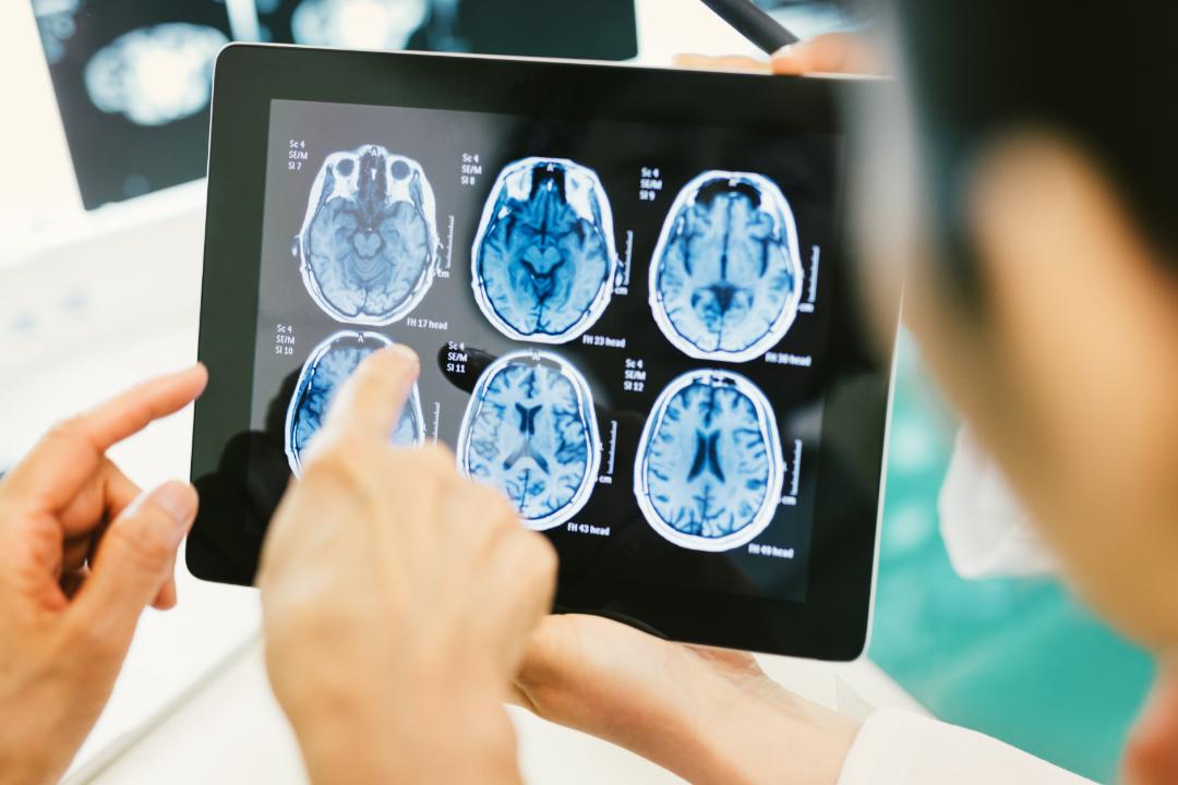 脑动静脉畸形介入手术风险,脑动静脉畸形无症状需要治疗吗