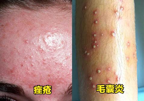 毛囊炎和湿疹的区别,毛囊炎是疮的范畴吗
