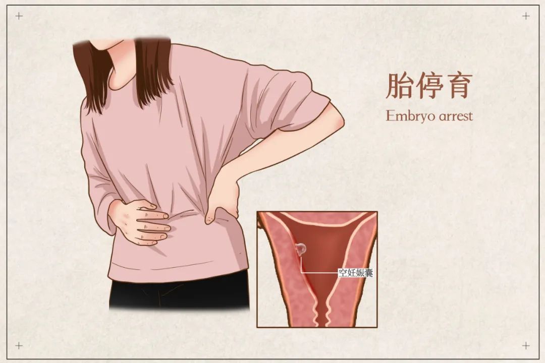 胚胎停育是精子的问题吗,胚胎停育染色体检查