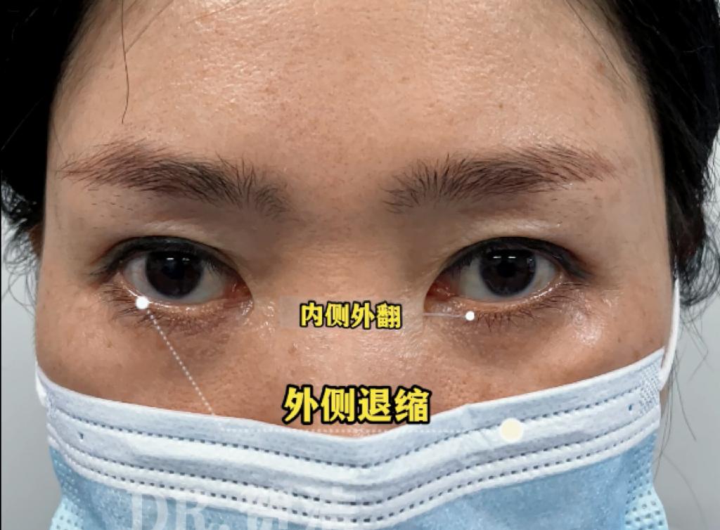 眼袋切坏了,眼袋切多了外翻怎么补救