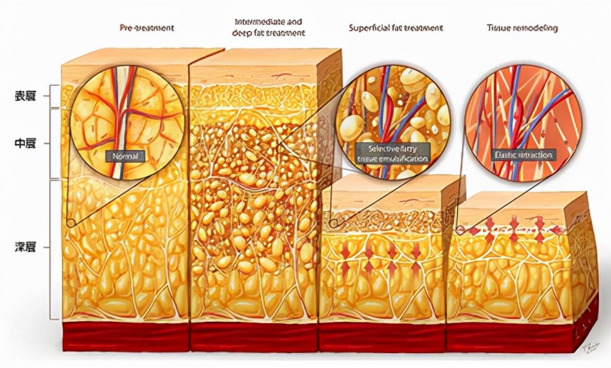 高周波吸脂瘦腿,吸脂可以瘦咬肌吗
