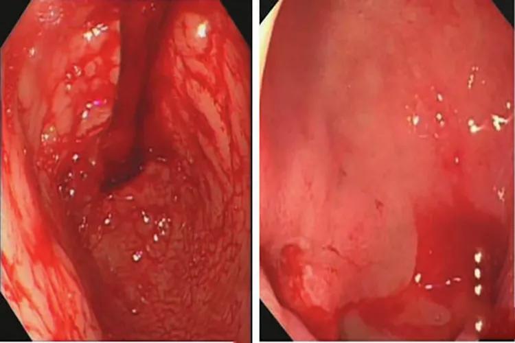 胃出血能活多久,胃出血吃什么药有效