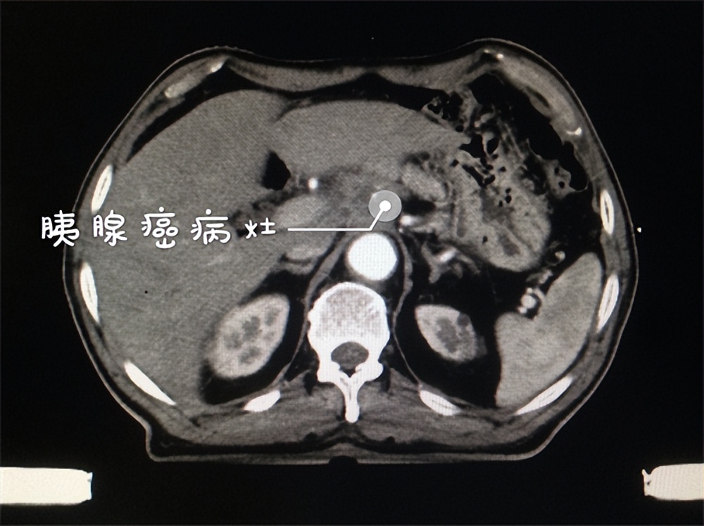 半年前肠镜检查正常但是一直腹泻,男子频繁拉肚子两次肠镜正常