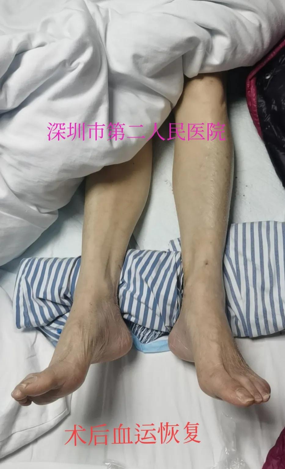 老年人小腿浮肿发紫什么原因,老人突然小腿发凉发软