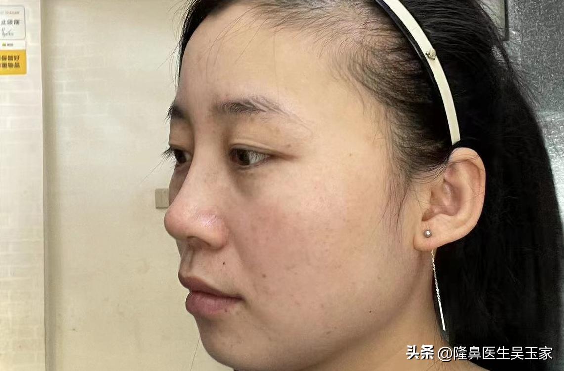 天津28岁姑娘动手术,29岁女子瞒着家人整容