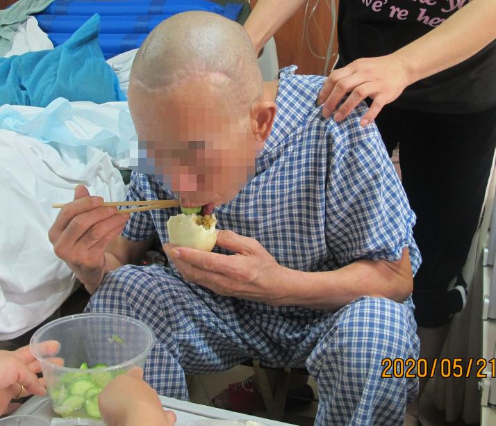 脑外伤后硬膜下积液颅骨修补,颅骨修复手术失败导致脑积水