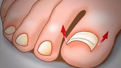 脚趾甲总往肉里长还疼是什么原因,脚趾甲老是戳到肉