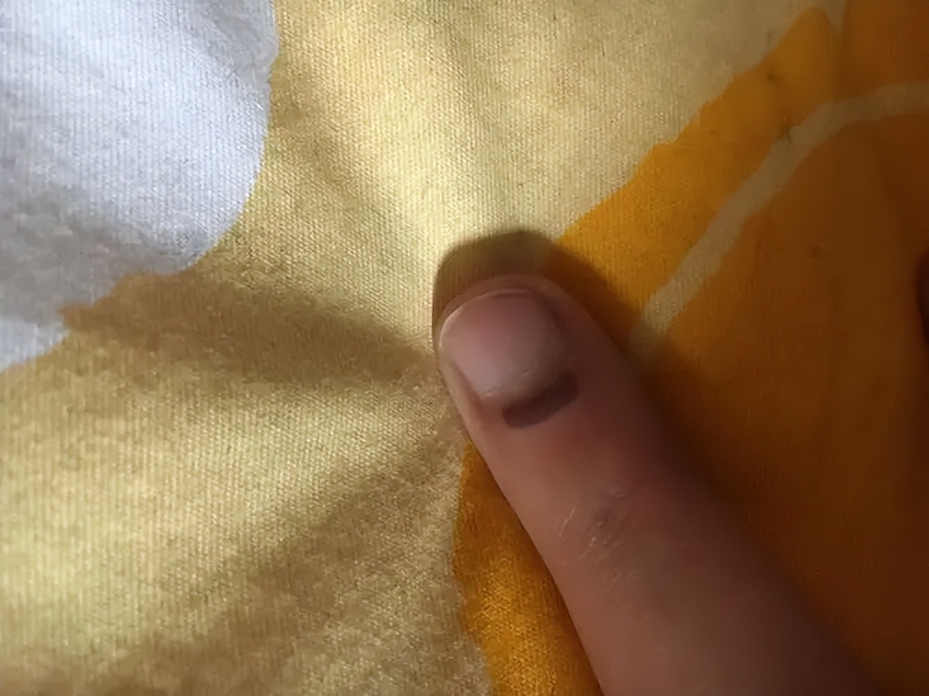 血瘀生百病简单化瘀就够了吗,血瘀体质如何快速祛血瘀