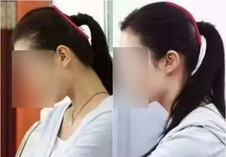 颅顶低发际线高怎么办,发际线高颅顶低怎么改善