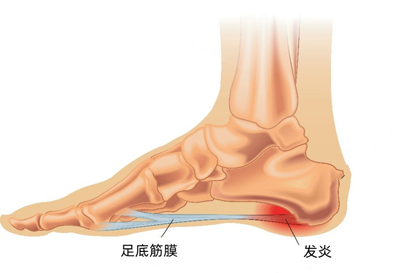 足底筋膜炎是脚底板疼吗,脚底板筋膜炎的症状及治疗