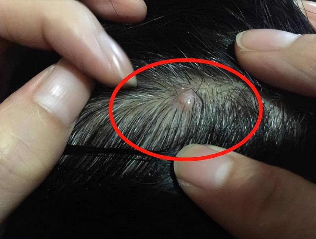 头皮长疙瘩和脓包是什么原因,为什么头皮上经常长脓包和疙瘩