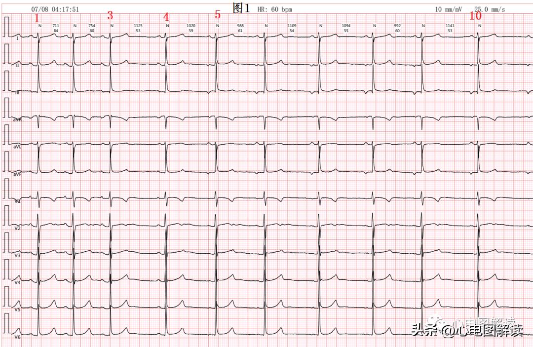 窦房结游走心律的临床意义,窦房结游走心律心电图特征