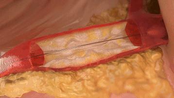 国内首个：波士顿科学血管“金刚钻”首次临床