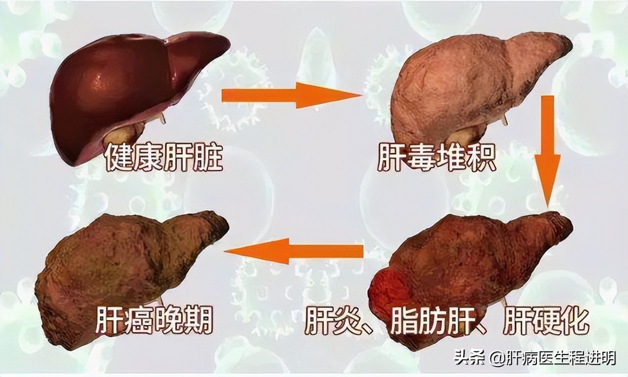 常见保肝护肝药一览,警惕药物性肝损伤