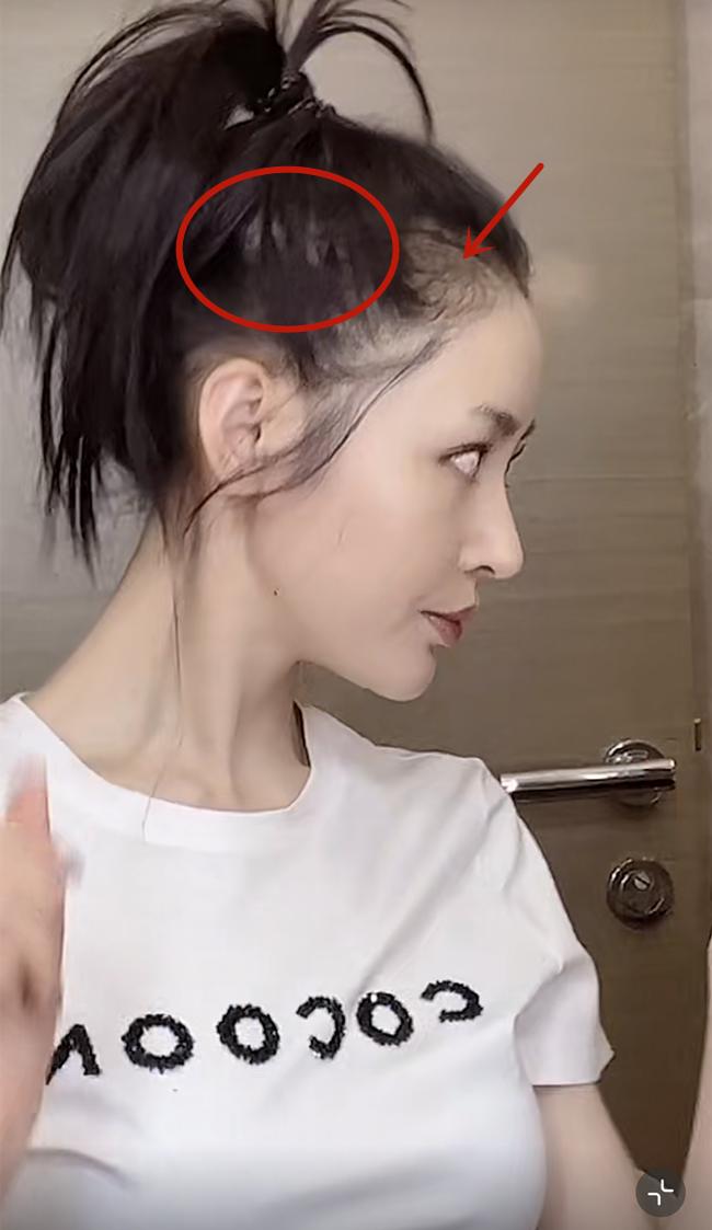 张天爱素颜录视频，头发稀疏头皮隐现！吴谨言同样也深陷脱发危机