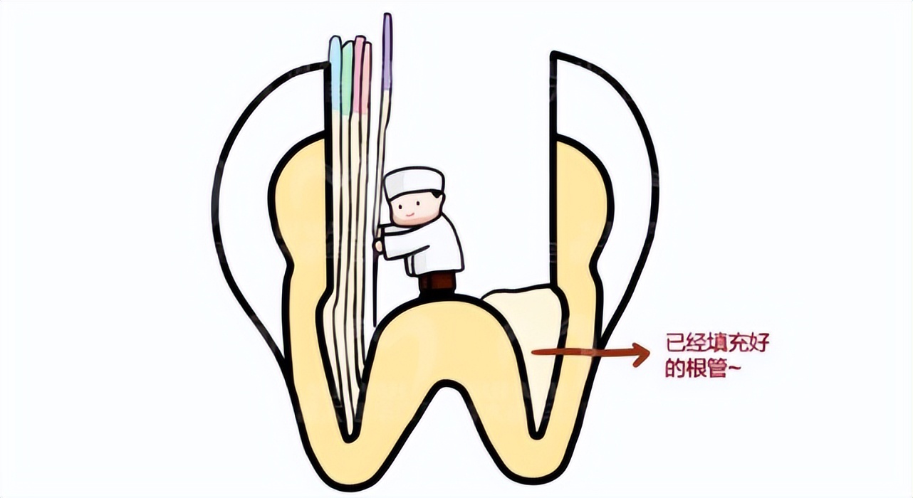 根管治疗后牙体修复,牙齿根管治疗亲身经历全过程