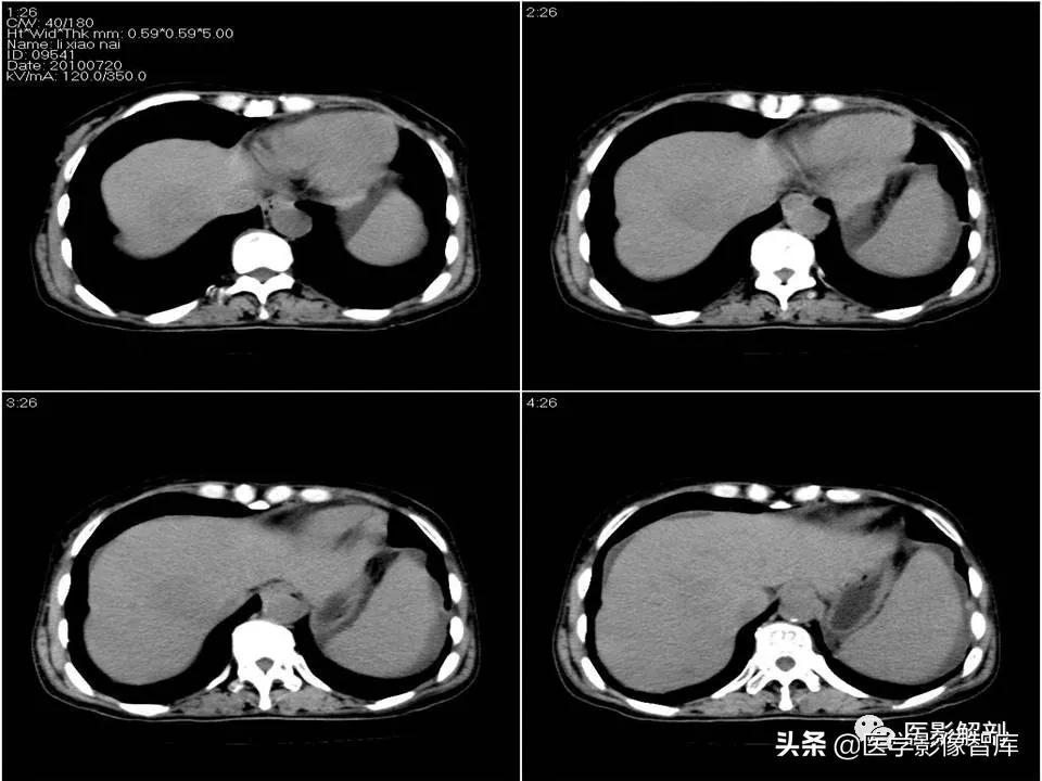 肝炎性假瘤鉴别诊断,肝炎性假瘤影像学表现