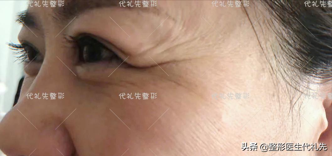 35岁眼周围皱纹多怎么办,35岁眼周有细纹怎么改善