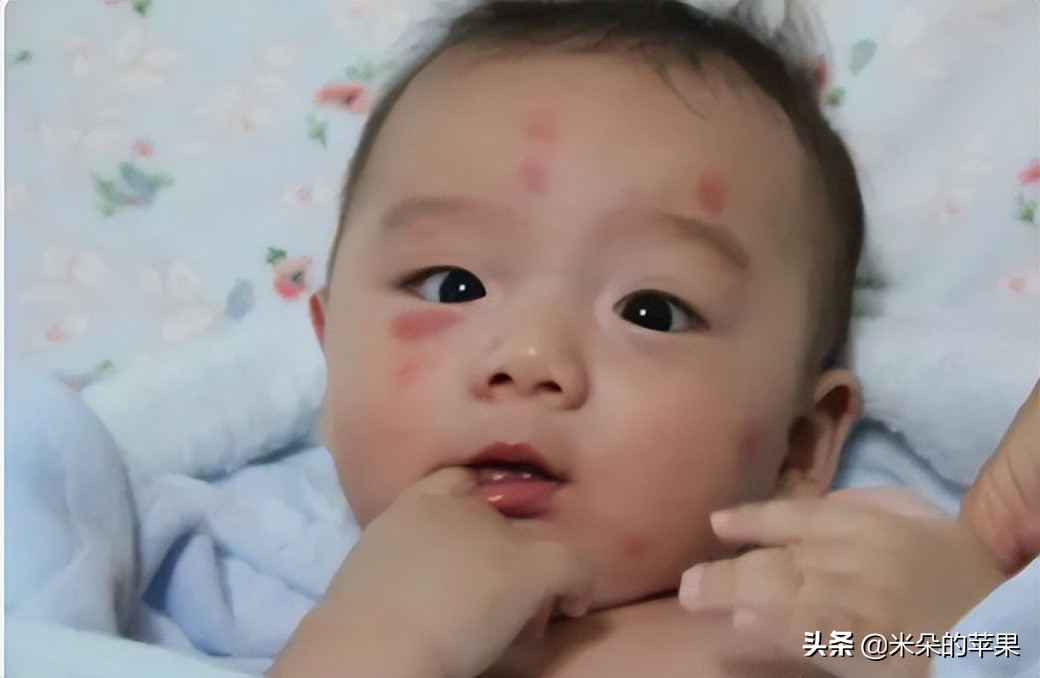 孩子被蚊子咬了很痒怎么办,孩子被蚊子咬痒得厉害怎么办