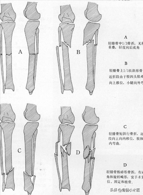 胫腓骨骨干骨折费用大概多少,胫腓骨骨干骨折能评几级伤残
