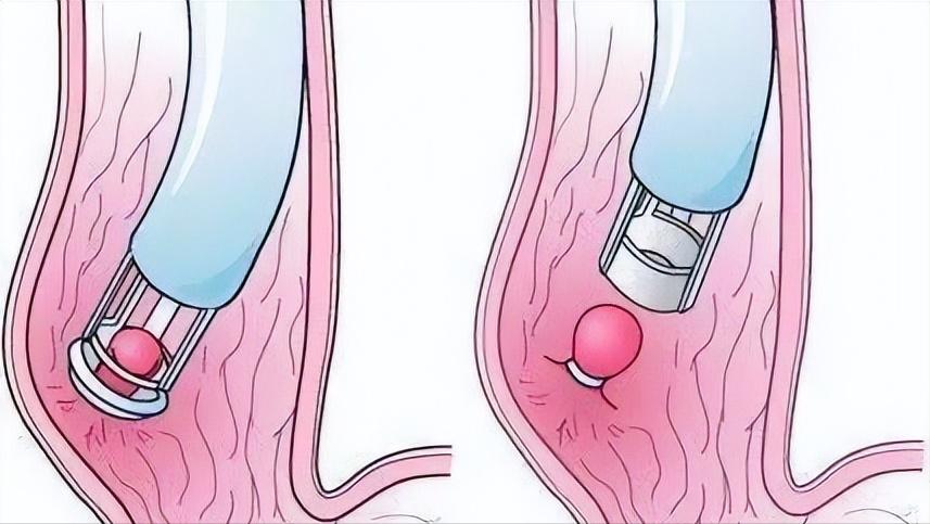 胃底静脉曲张出血中医治疗,食管静脉曲张出血内镜治疗方法