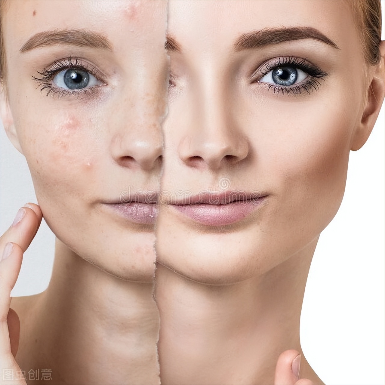 脸上出油爱长痘痘怎么调理,脸上爱出油怎么控油