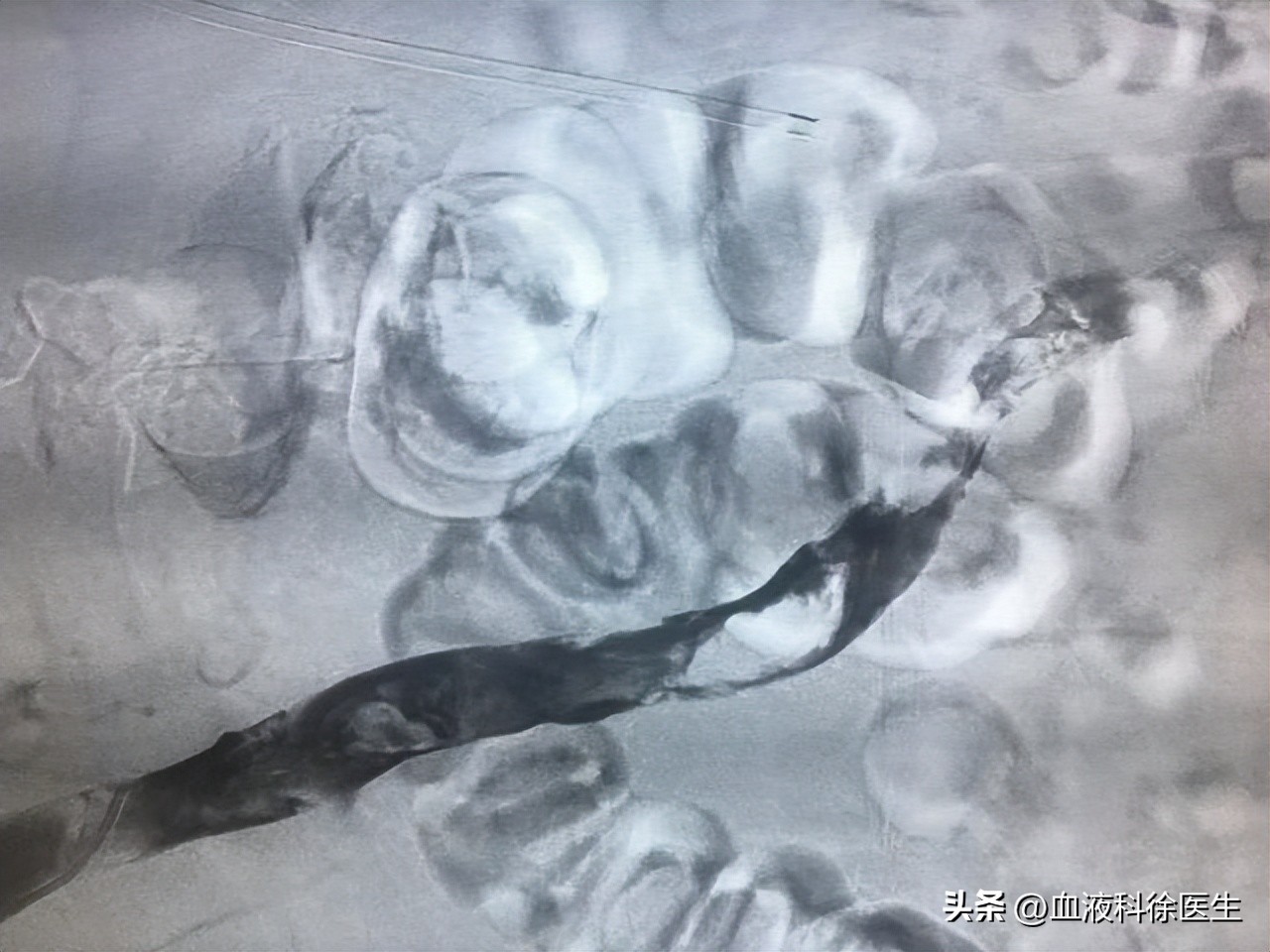血栓来临腿部先知,血栓病手脚有什么症状