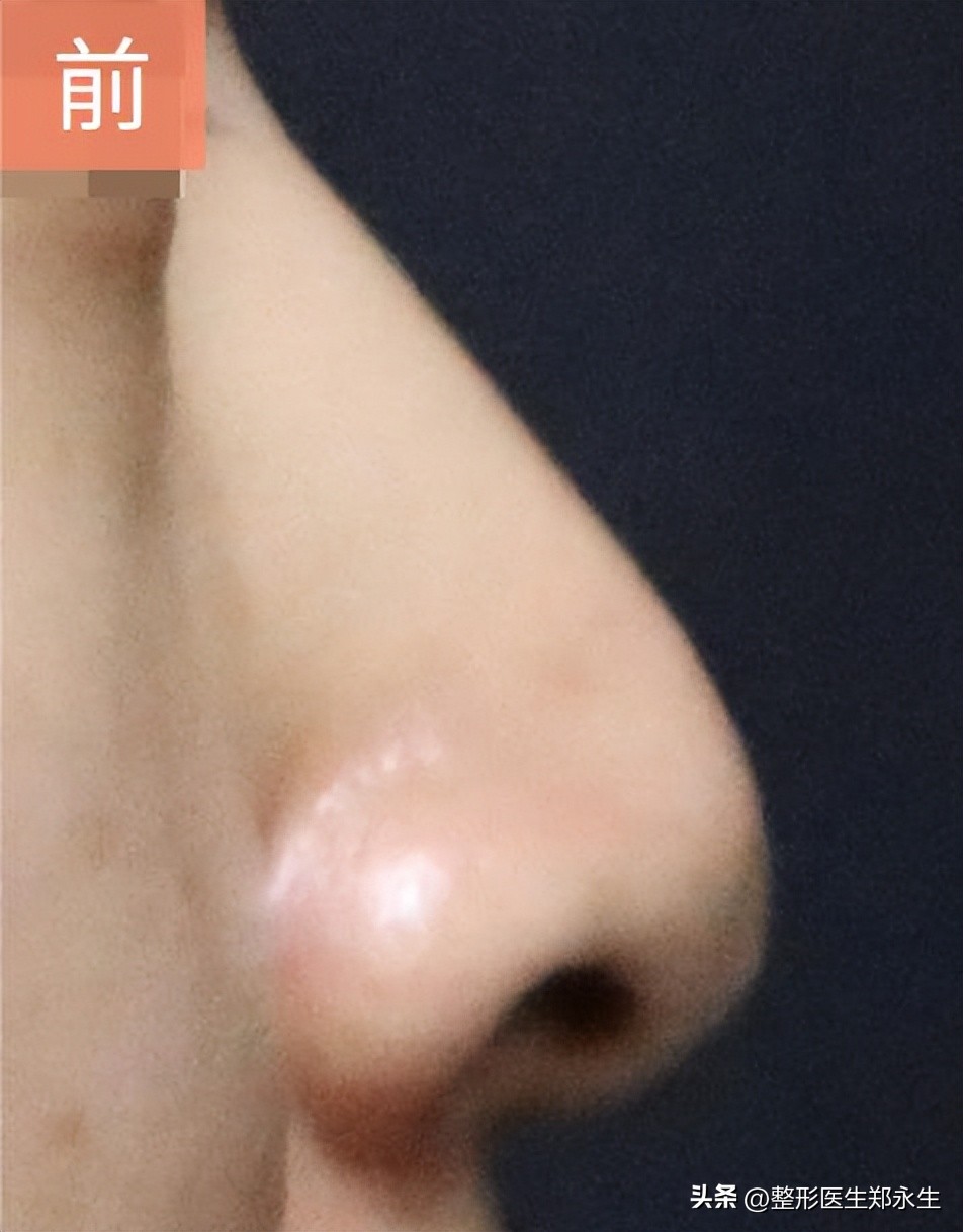 鼻子不满意在原医院修复要钱吗,鼻子坑修复最有效的方法