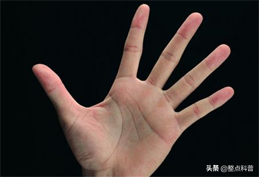 民间断掌纹说法,断掌纹与先天疾病