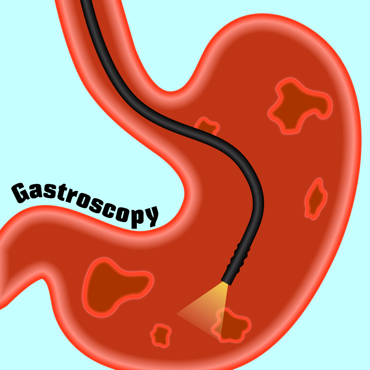 做胃镜选择无痛还是常规的好,做胃镜做一般的好还是无痛的好