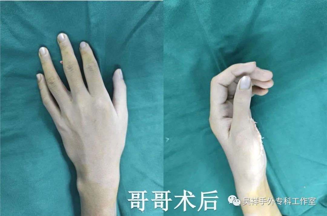 罕见同卵不同性别的双胞胎,罕见四胞胎长得一模一样