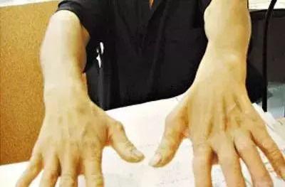 手腕无力手指笨拙虎口萎缩,手臂手掌无力萎缩的症状