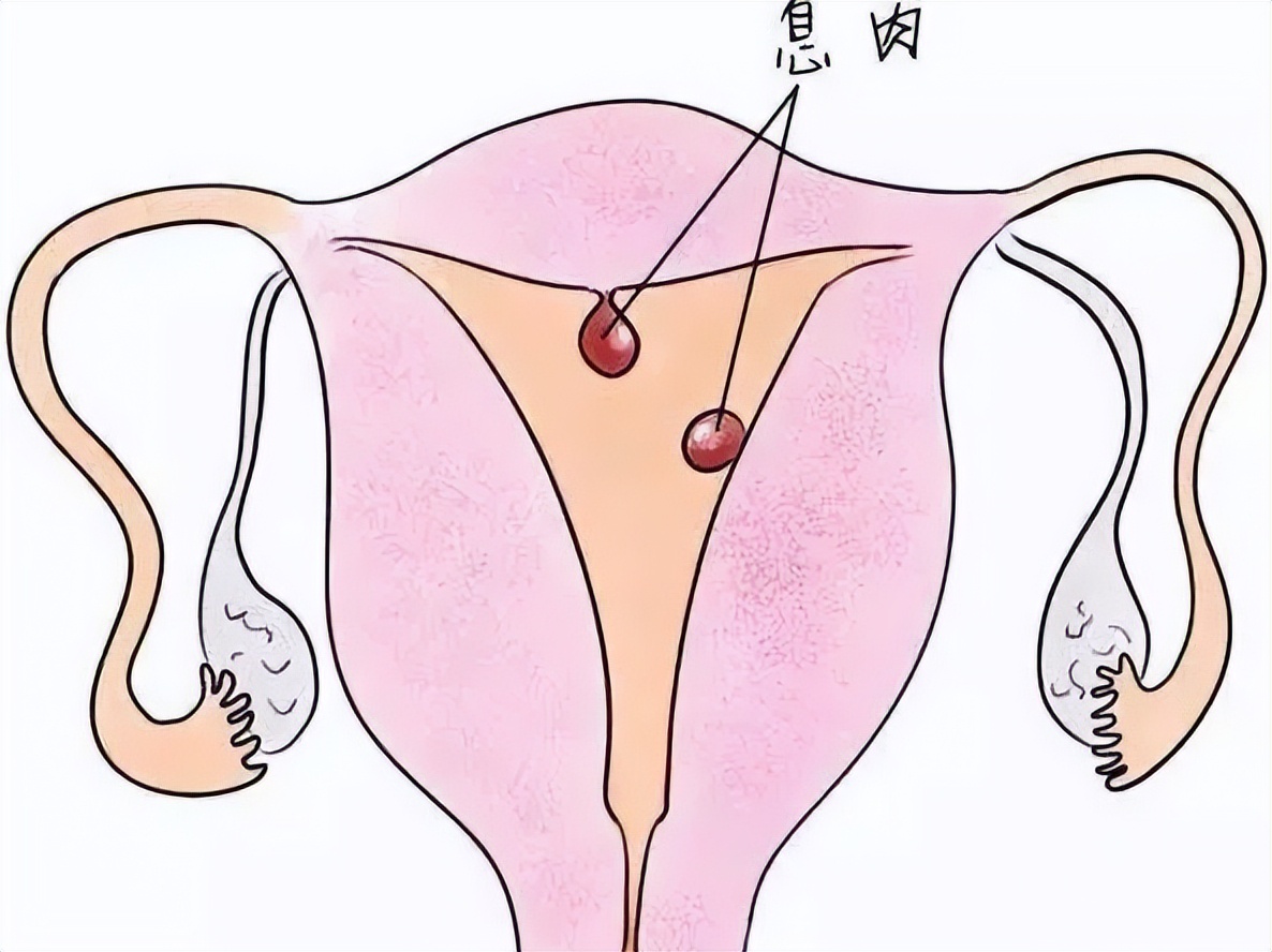 当上班族要做宫腔镜手术,怎样请假才不被扣工资?