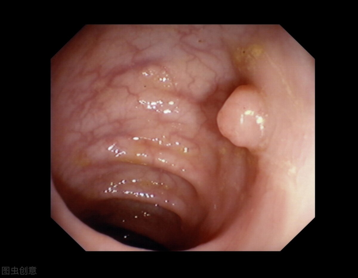 不同部位的多发息肉如何取病理,身上多处长息肉是怎么回事