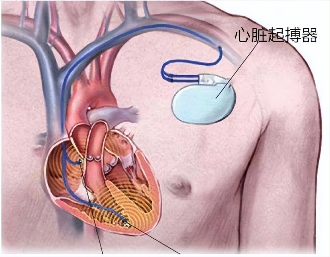 心电图窦性心律不齐什么意思呀,做心电图窦性心律不齐有什么症状