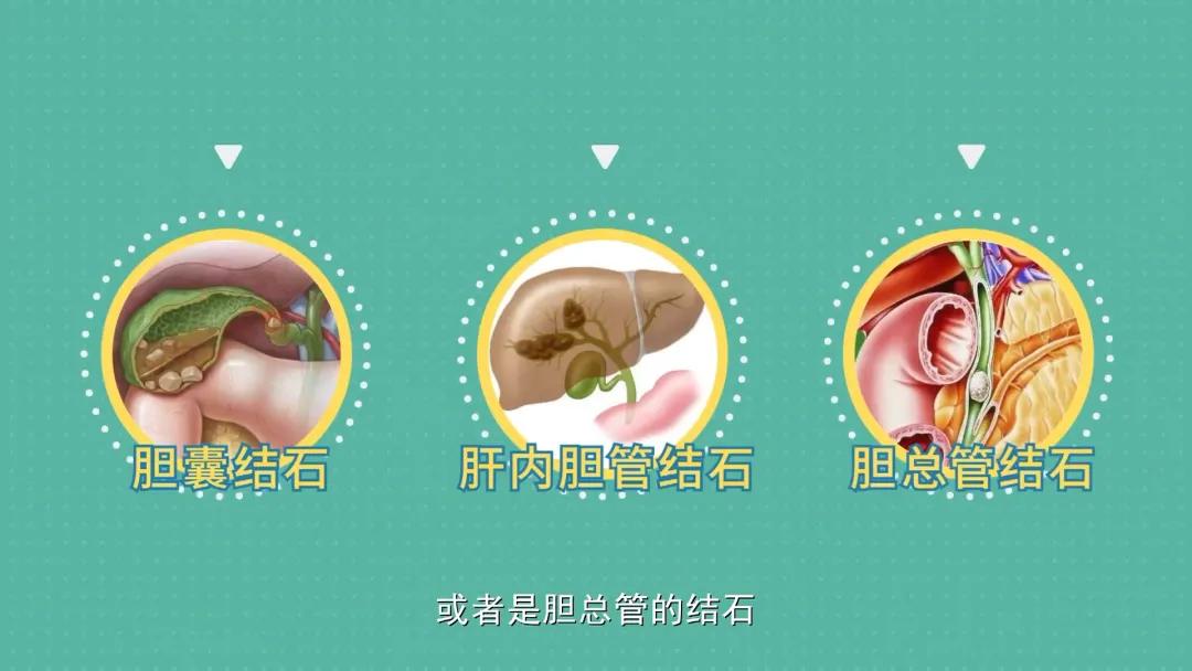 中医对胆石症有啥良方,胆石的中医辨证分型有哪些