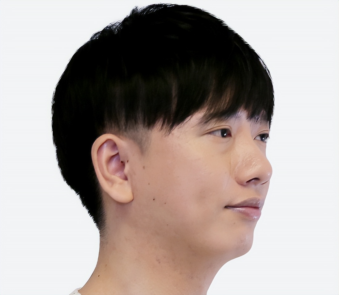 30岁男脸上痘坑可以祛除吗,小伙子痘坑修复亲身经历