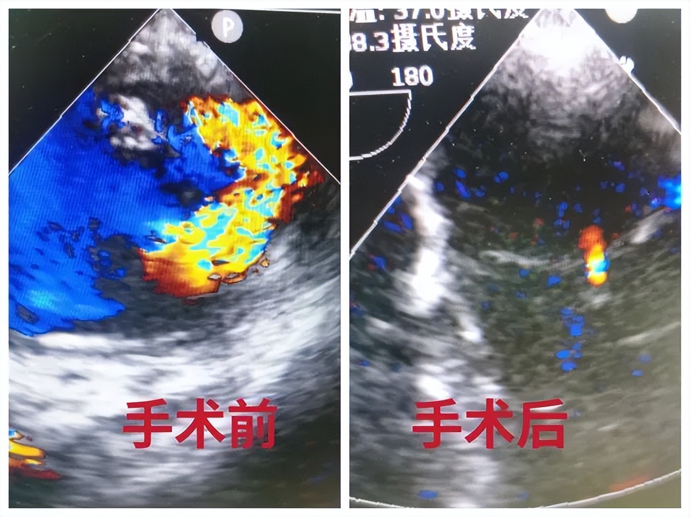 渭南市中心医院成功完成儿童先天性二尖瓣畸形成形术