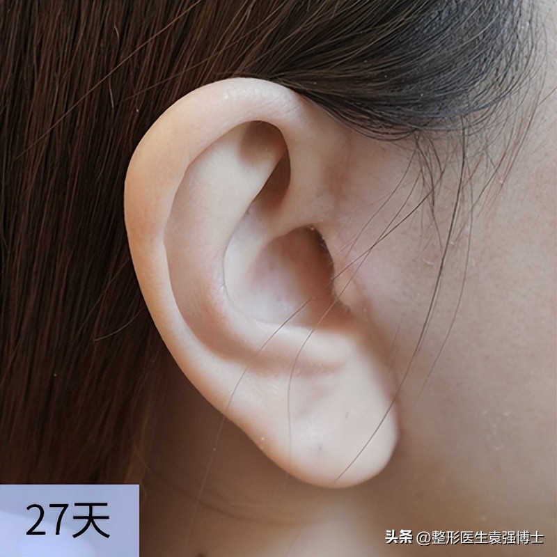 55岁后适合做拉皮手术吗,60岁适合做拉皮手术吗