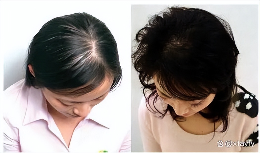 植发前先来算算植发该花多少钱,植发一般花多少钱就够了