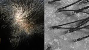 头皮屑特别多怎么去除最简单方法,头皮屑太多在家里怎么处理