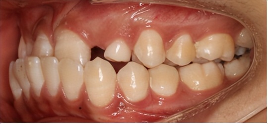 暑期牙齿矫正黄金季,牙齿矫正省钱攻略