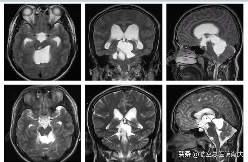 软性神经内镜个性化微创治疗，解除患者多年病痛折磨！
