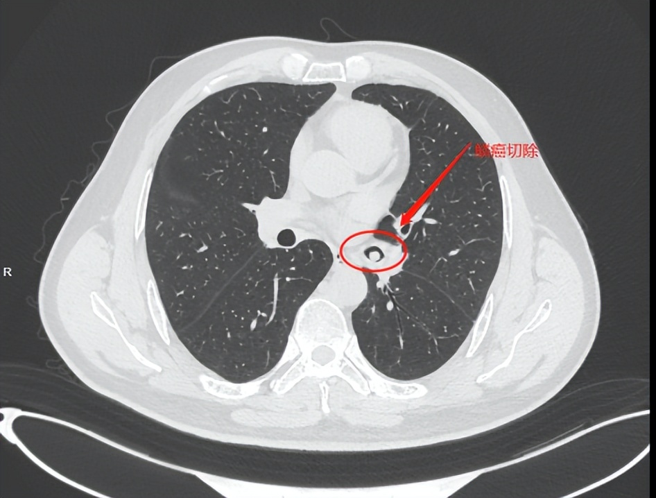 左肺乳头状鳞状细胞癌已手术，右肺的8mm肺结节现在怎么办？