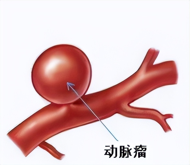 门医技术|区医院肿瘤与介入科成功解除藏在患者体中的“定时*弹炸**”——动脉瘤