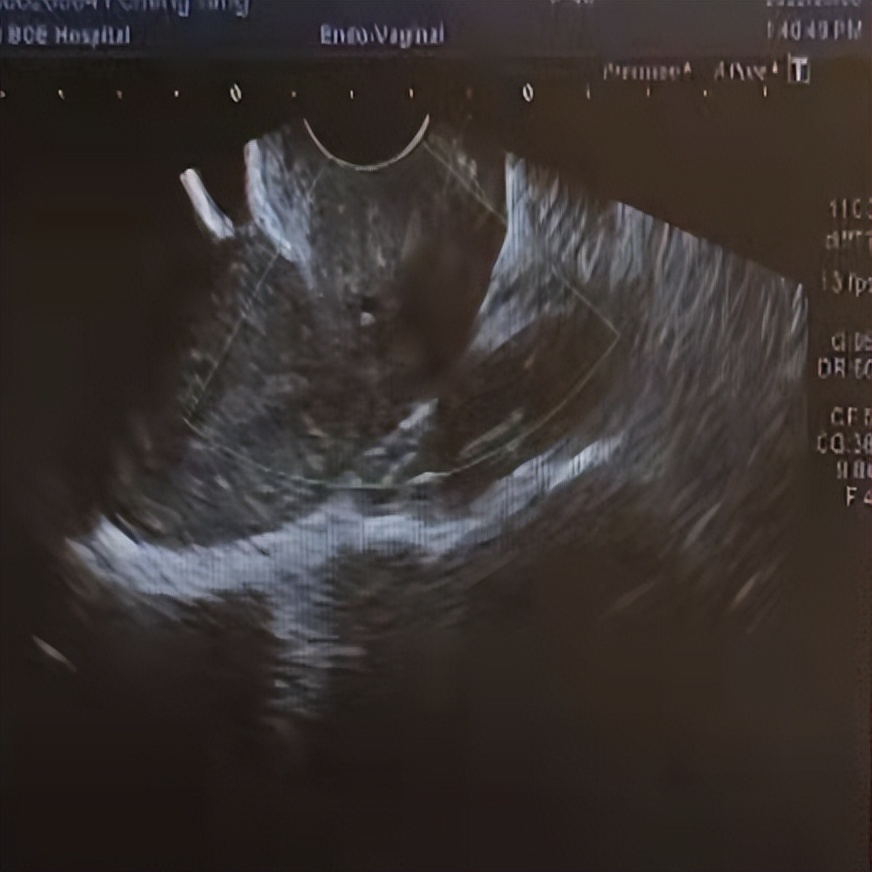 卵巢囊肿微创手术后能清理干净吗,腹腔镜下卵巢囊肿切除术的步骤