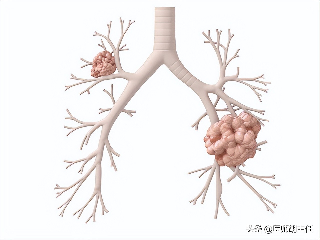 肺癌导致的肩膀疼是什么症状,肺癌导致肩膀疼痛的症状