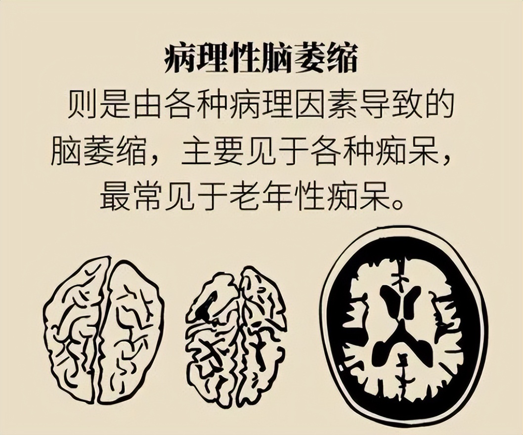 脑萎缩不可轻视应尽早防治,岁数大了脑萎缩吃什么药