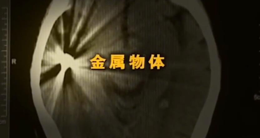 故事:江苏70岁老人头疼欲裂,检查时发现颅内有*弹子**,吓坏在场医生