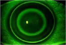 南阳南石眼科医院角膜塑形镜,南阳硬性角膜塑形镜